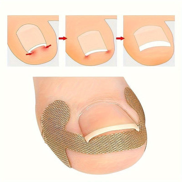 Ingrown Nail Correction Bandage for Relief from Paronychia and Nail Issues 5 Sheets 20 pieces