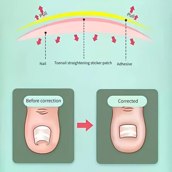 Ingrown Nail Correction Bandage for Relief from Paronychia and Nail Issues 5 Sheets 20 pieces