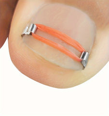 Ingrown Toenail Correction Kit with Nail Hooks Rubber Rings Crochet Needle and Tape for Effective Treatment