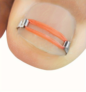 Ingrown Toenail Correction Kit with Nail Hooks Rubber Rings Crochet Needle and Tape for Effective Treatment